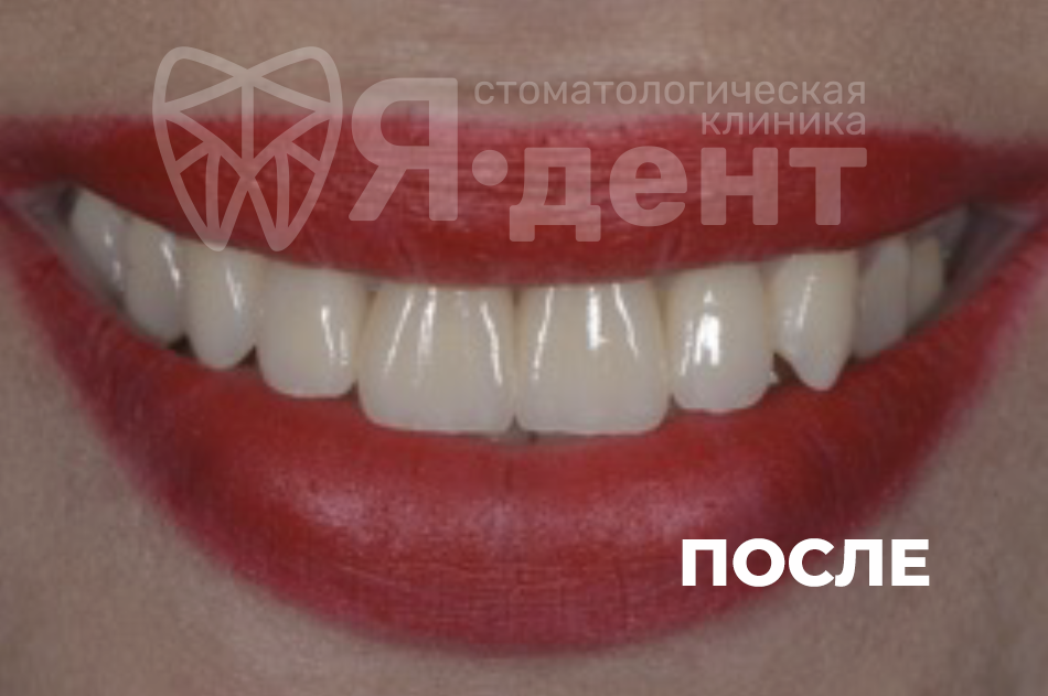После
