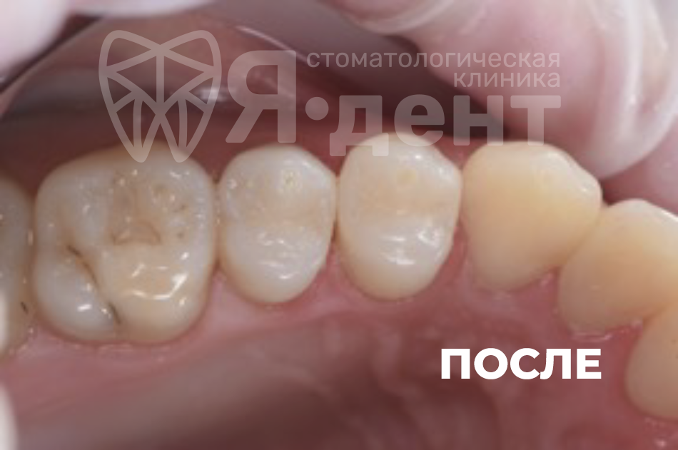 После